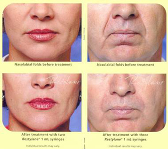 Restylane | Dr. Moulton-Barrett